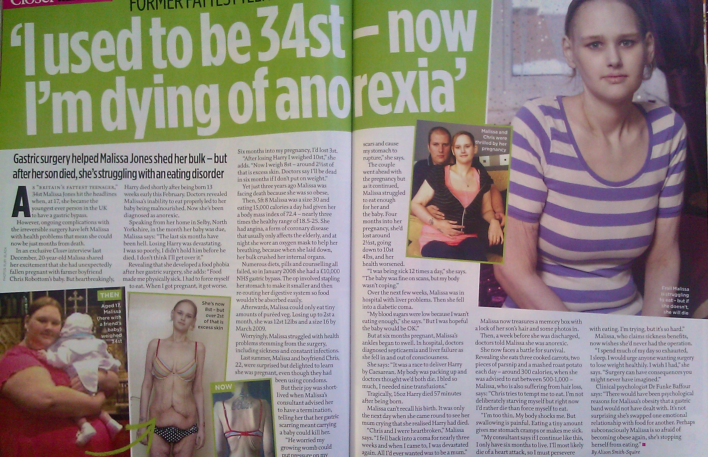 Malissa once weighed 34 st - now she's dying from anorexia